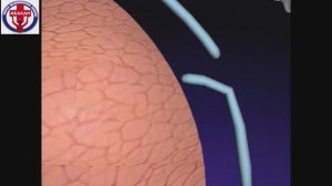 напряжённый / клапанный пневмоторакс. Тактика оказания помощи