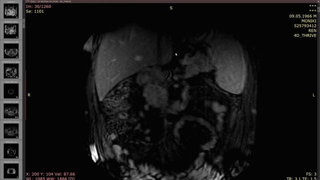 L00586 МРТ почек - клинические случаи. Часть 1 Дуброва С.Э.