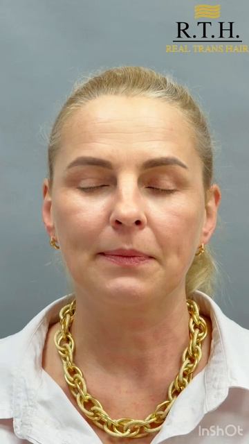 Месяц после верхней и нижней блефаропластики