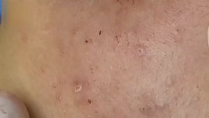 Удаление подкожного акне — глубокая чистка лица