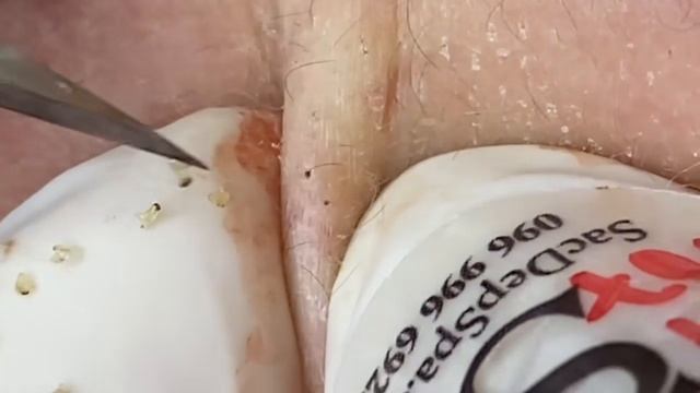 Выдавливание прыщей, угрей, черных точек и камедонов #363