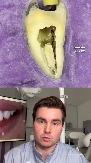 С расскажу, как выглядит лечение корневых каналов зуба  в разрезе