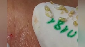 Выдавливание прыщей, угрей, черных точек и камедонов #364