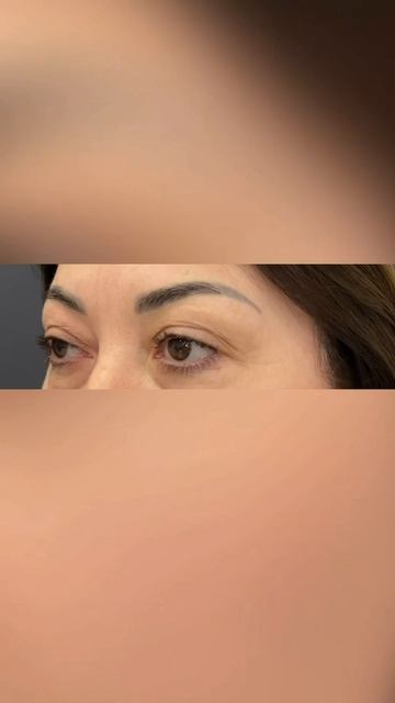 #верхняя_и_нижняя_блефаропластика: 1 месяц после операции