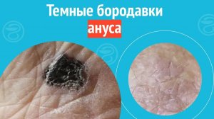 😦 Темные бородавки ануса. Клинический случай №1294