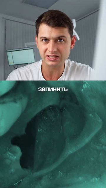 ОСЛ с перфорацией мембраны Шнайдера