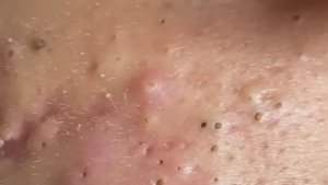 Удаление кистозного акне — работа с тяжелыми случаями #887579