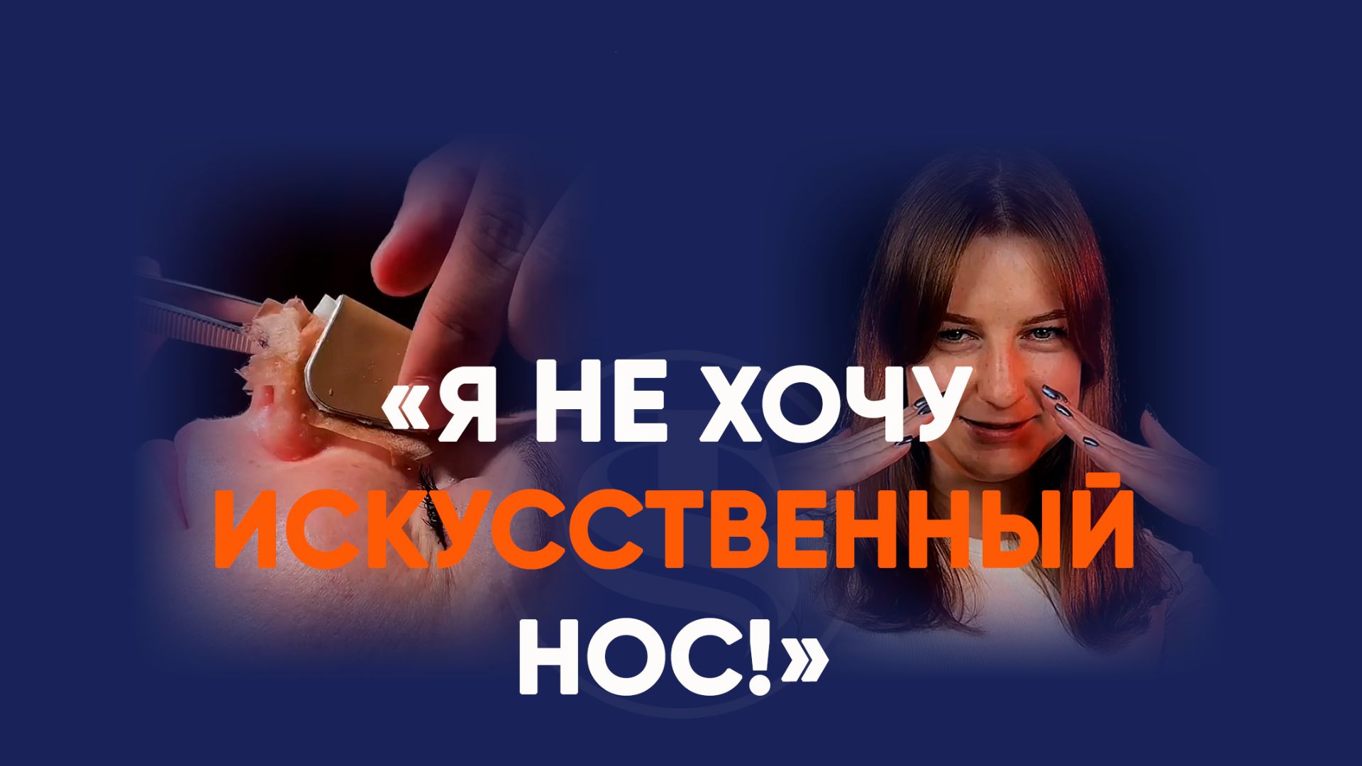 Открытая риносептопластика: как меняется нос в первые 6 месяцев