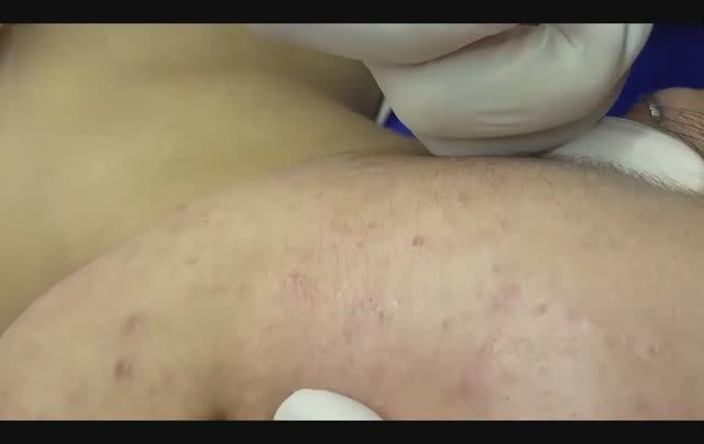 Глубокое удаление акне крупным планом