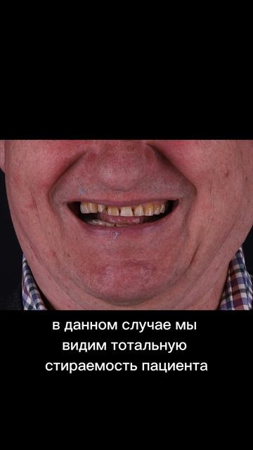 Восстановление стёртых зубов у пациента 60  До и После