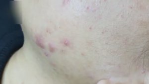 Удаление воспаленного акне - тотальная очистка