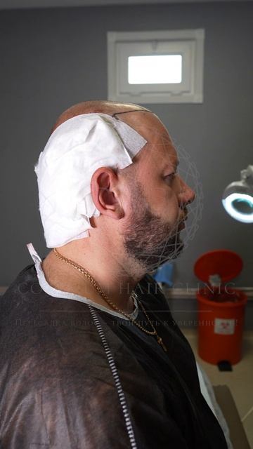 Пересадка волос в клинике Colesium Hair Clinic