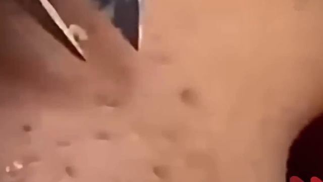 #265 Чистка лица от угрей и акне. Выдавливание прыщей. Удаление черных точек и комедонов