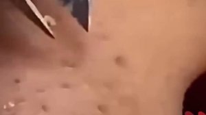 #265 Чистка лица от угрей и акне. Выдавливание прыщей. Удаление черных точек и комедонов