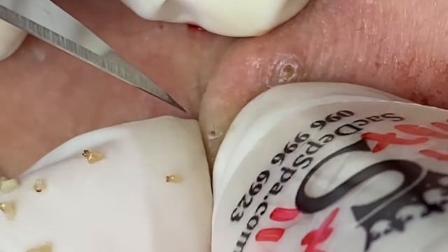 Выдавливание прыщей, угрей, черных точек и камедонов #362