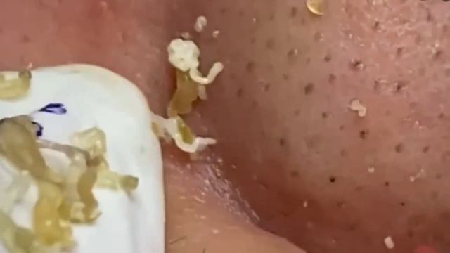 #266 Чистка лица от угрей и акне. Выдавливание прыщей. Удаление черных точек и комедонов