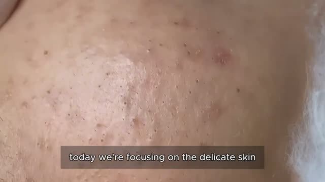 Удаление акне: путь от отчаяния к чистой коже #𝟗𝟎455