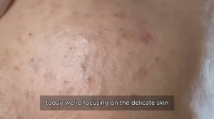 Удаление акне: путь от отчаяния к чистой коже #𝟗𝟎455