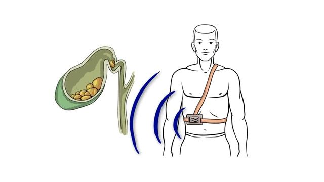 Удаление камней из желчного без дробления