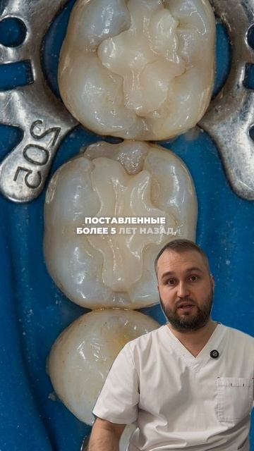 Коронка на зуб кому и когда нужна