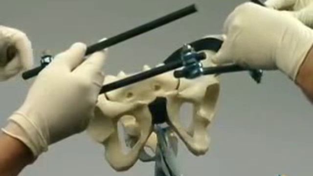 ExFix Pelvic. АНФ на таз.