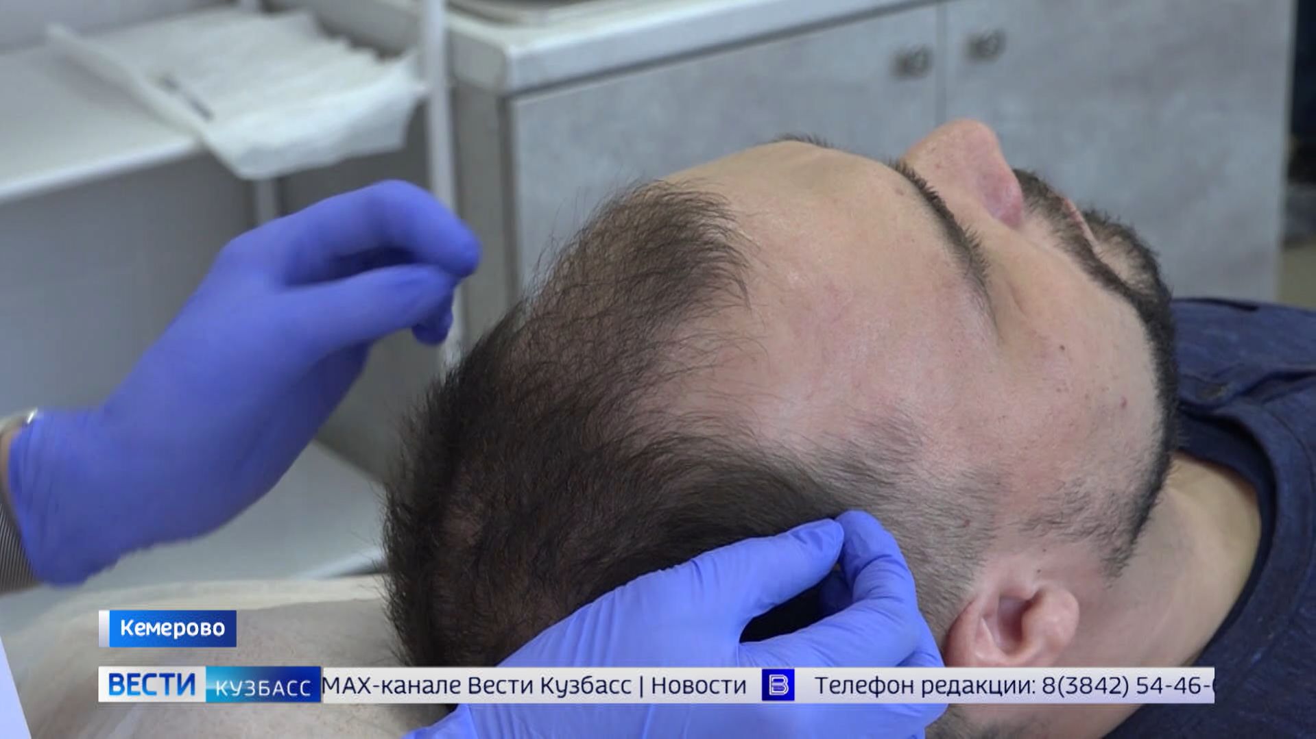 В Кемерове проводят уникальную процедуру пересадки волос на самом высоком уровне