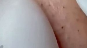 #267 Чистка лица от угрей и акне. Выдавливание прыщей. Удаление черных точек и комедонов