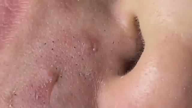 Глубокие скрытые прыщи под кожей. Часть 2