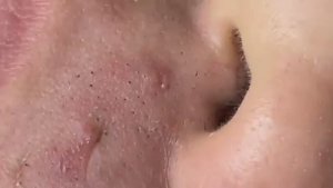 Глубокие скрытые прыщи под кожей. Часть 2