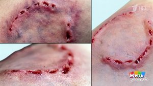 Укусы диких животных. Жить здорово! Фрагмент выпуска от 17.04.2026