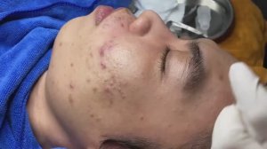 Глубокие скрытые прыщи под кожей. Часть 1