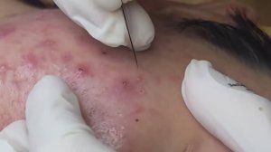 Скрытые прыщи под кожей, воспаленное акне. Часть 1