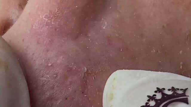 Скрытые прыщи под кожей, воспаленное акне. Часть 2