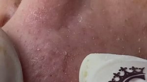 Скрытые прыщи под кожей, воспаленное акне. Часть 2