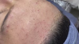 072 • Acne collection • АСМР • Relax Spa