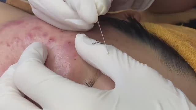 Скрытые прыщи под кожей воспаленное акне вызывающие скопление крови. Часть 1