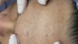 075 • Acne collection • АСМР • Relax Spa