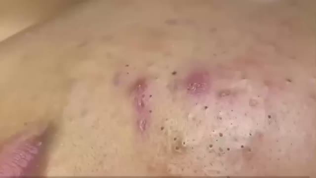 270 Чистка лица от угрей и акне. Выдавливание прыщей. Удаление черных точек и комедонов