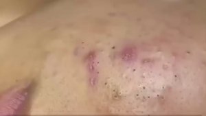 #270 Чистка лица от угрей и акне. Выдавливание прыщей. Удаление черных точек и комедонов