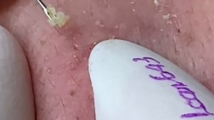 #269 Чистка лица от угрей и акне. Выдавливание прыщей. Удаление черных точек и комедонов