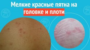 👉 Мелкие красные пятна на головке и плоти. Клинический случай №1284