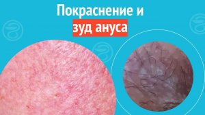 😡 Покраснение и зуд ануса. Клинический случай №1283