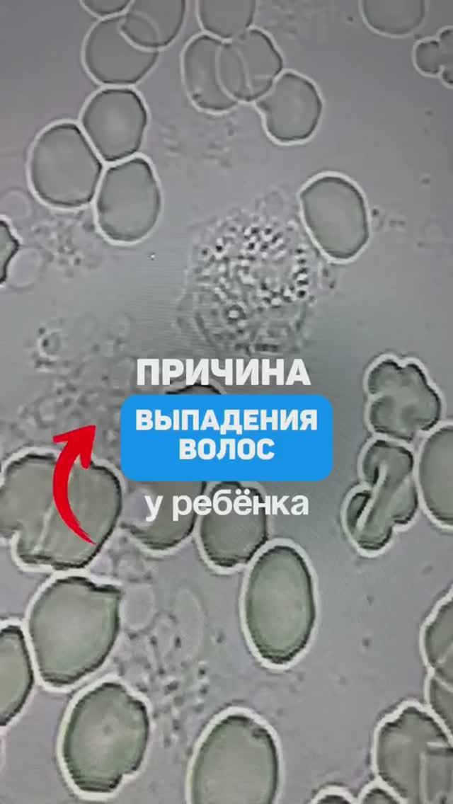 Причина выпадения волос у ребенка. Алопеция, дерматиты. Семейный доктор Алена Братишко
