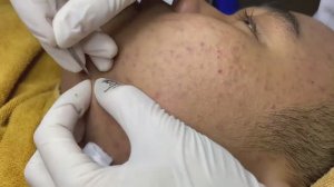 Подкожные прыщи покрывают всё лицо — удаление скрытого акне.