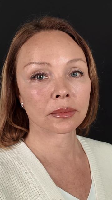 Полгода после deepplanefacelift и deepnecklift.