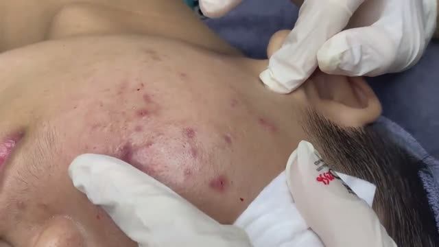 073 • Acne Collection • АСМР • Relax Spa