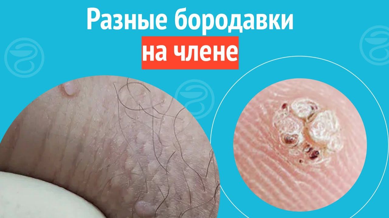  Разные бородавки на члене. Клинический случай 1285