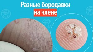 😒 Разные бородавки на члене. Клинический случай №1285