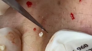 Выдавливание прыщей, угрей, черных точек и камедонов #366