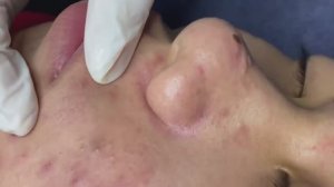 076 • Acne collection • АСМР • Relax Spa